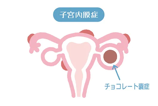 子宮内膜症とチョコレート嚢胞
