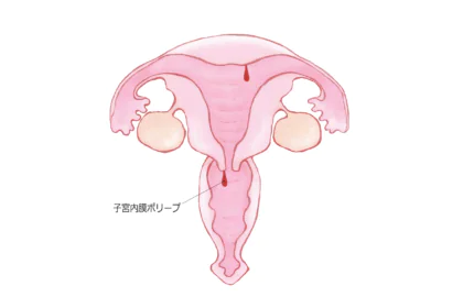 子宮内膜ポリープ