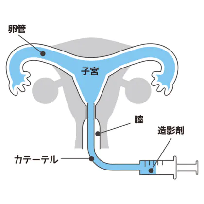 子宮卵管造影検査